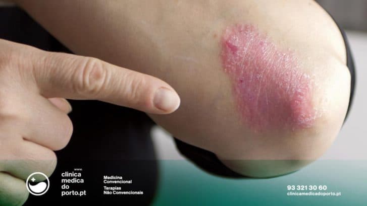 Psoríase - Homoepatia na Hepatite - Excessos Alimentares - Clinica Medica do Porto